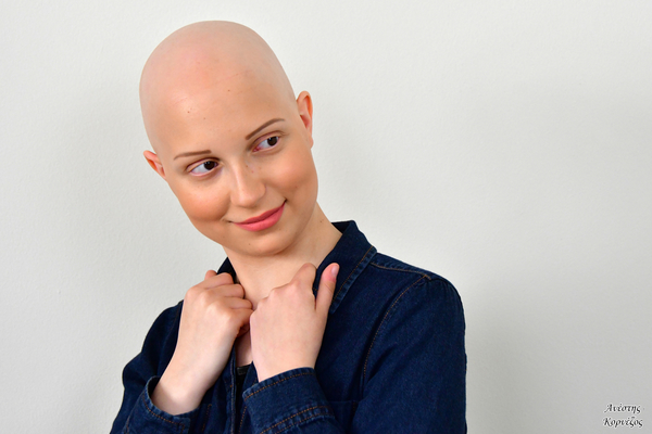 Alopecia - Photo credits @Anesis_Kornezos