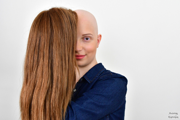 Alopecia - Photo credits @Anesis_Kornezos