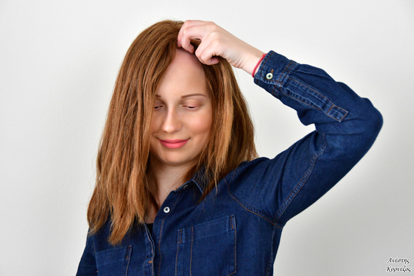 Alopecia - Photo credits @Anesis_Kornezos